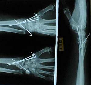 Broken Wrist X-Ray